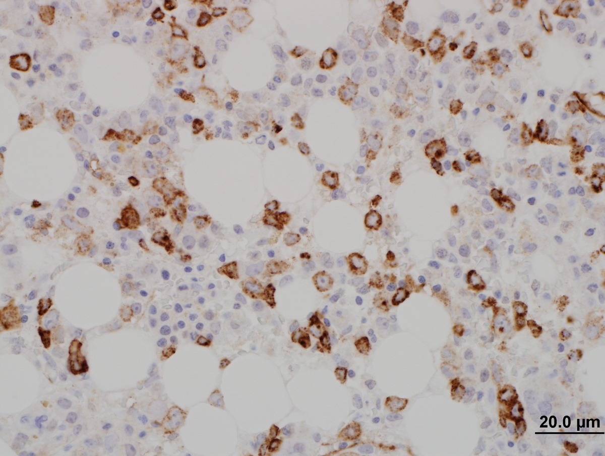 CD34 stain of the bone marrow biopsy